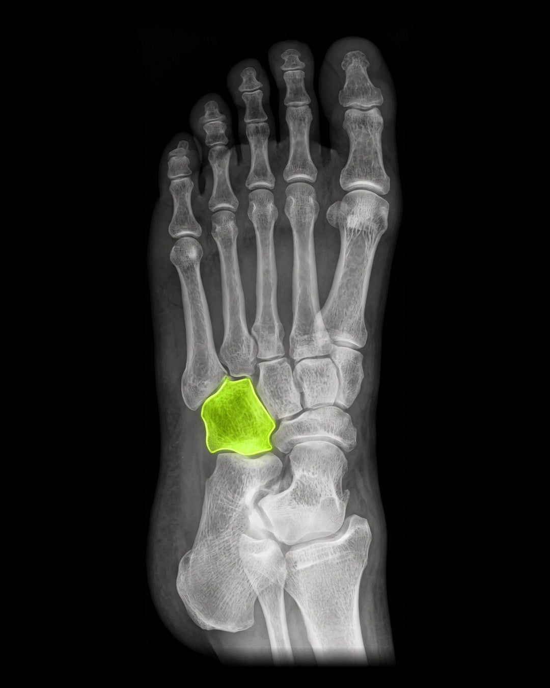Foot X-ray with the cuboid bone highlighted in lime on the outer side of the midfoot